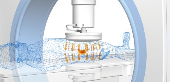 ハイパーサーミア（がん温熱治療）の原理